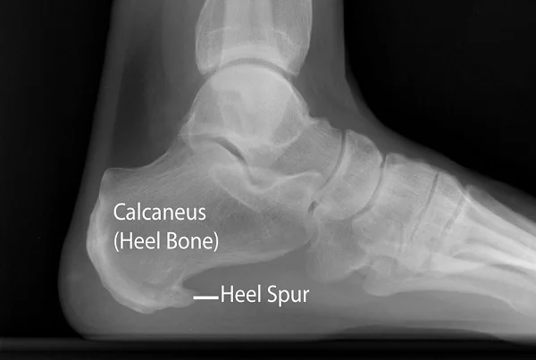 Plantar Fasciitis and Calcaneal Spur